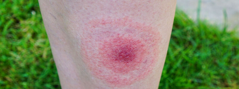 67 year old woman unusual rash