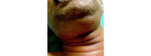 swollen-neck-copy