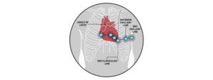 Placement of chest electrodes