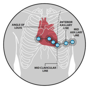 Placement of chest electrodes