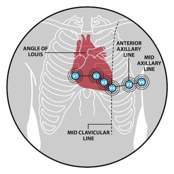 Placement of chest electrodes