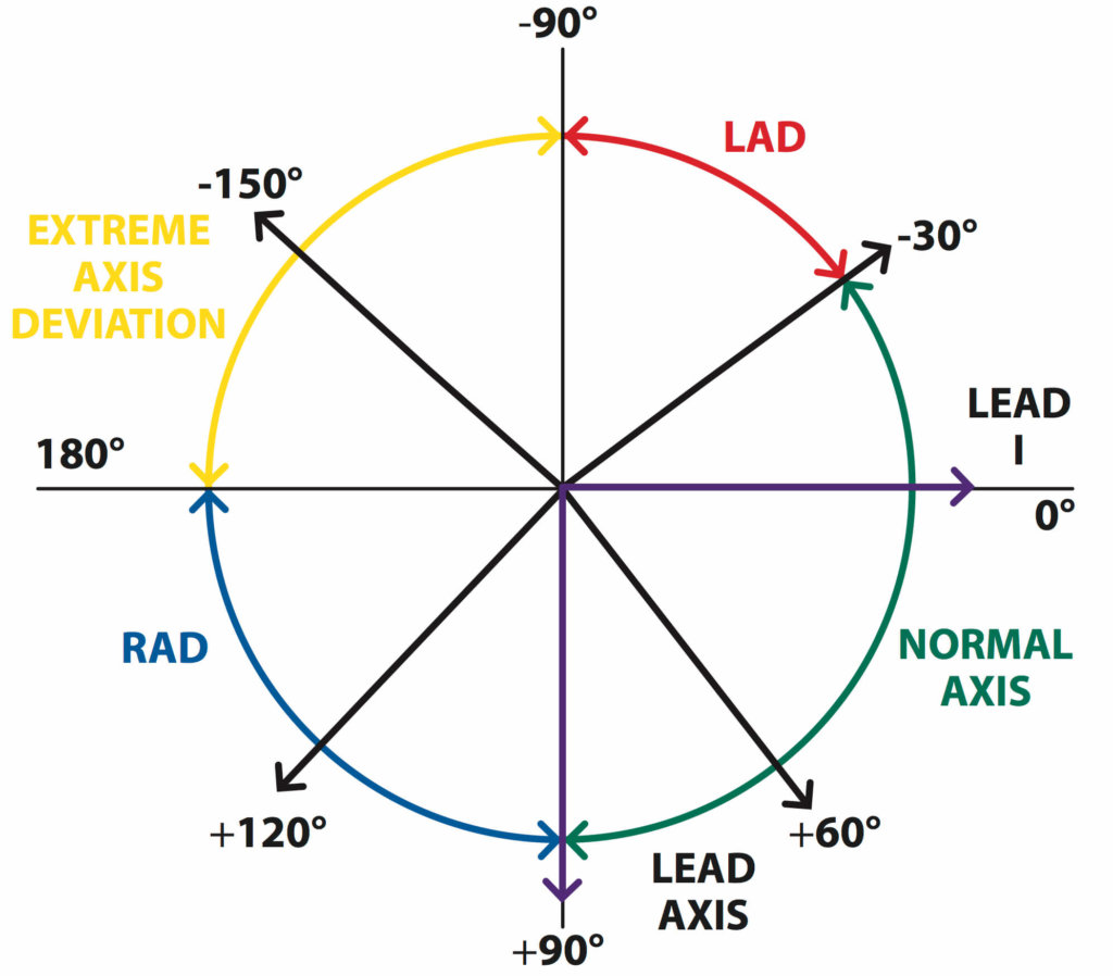 Figure 6. The relationship between leads I and AVF and the QRS axis. © Medical Exam Prep