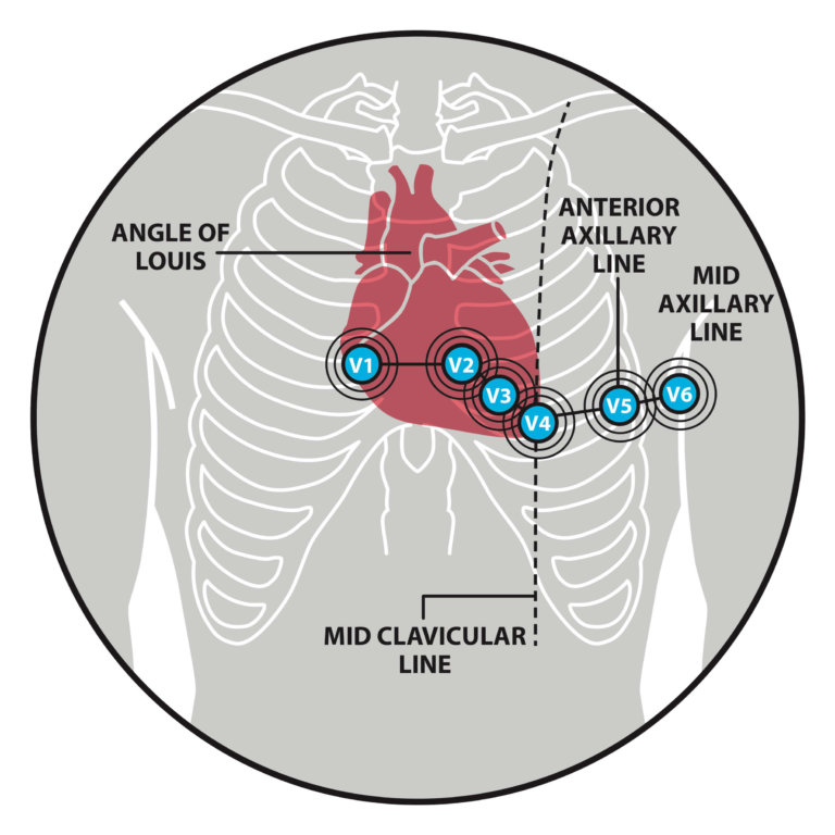 Placement of chest electrodes Medical Exam Prep