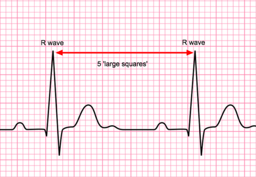 The Basics of ECG Interpretation (Part 2 – Rate, Rhythm and Axis ...