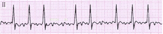 Figure 3. Rhythm strip demonstrating atrial fibrillation.