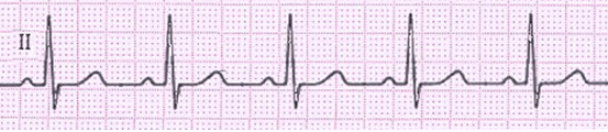 Figure 4. Rhythm strip demonstrating normal sinus rhythm.