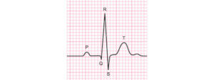 Basics of ECG Interpretation