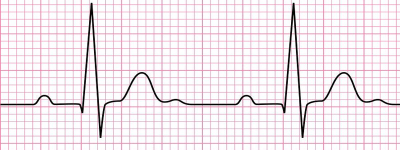 The Basics of ECG Interpretation (Part 3 – Waves, Segments & Intervals)