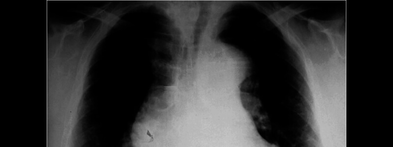 ‘Ripping’ Chest Pain in a 38-Year-Old Man