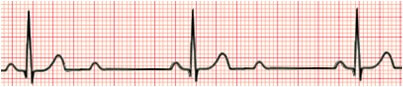 bradycardia