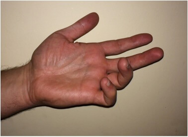 ulnar-claw