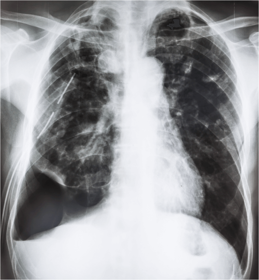 x-ray