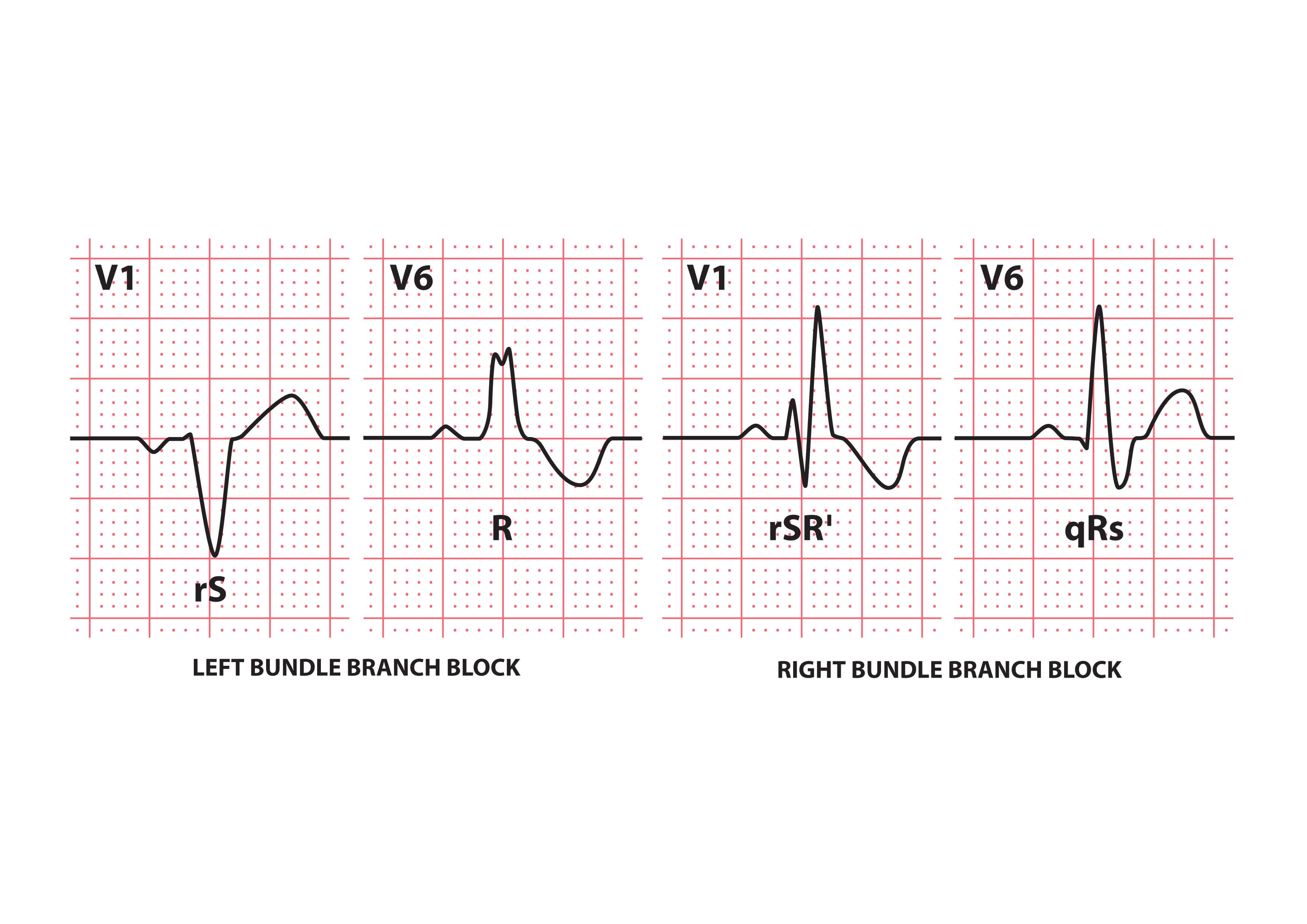 Bundle Branch Block