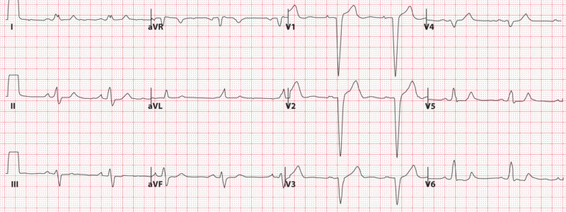 Bundle Branch Blocks (Part 1 – Left and Right Bundle Branch Blocks) Left bundle branch block