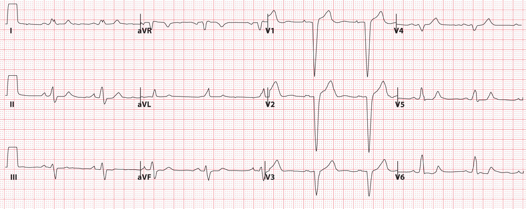 Bundle Branch Blocks  (Part 1 – Left and Right Bundle Branch Blocks)