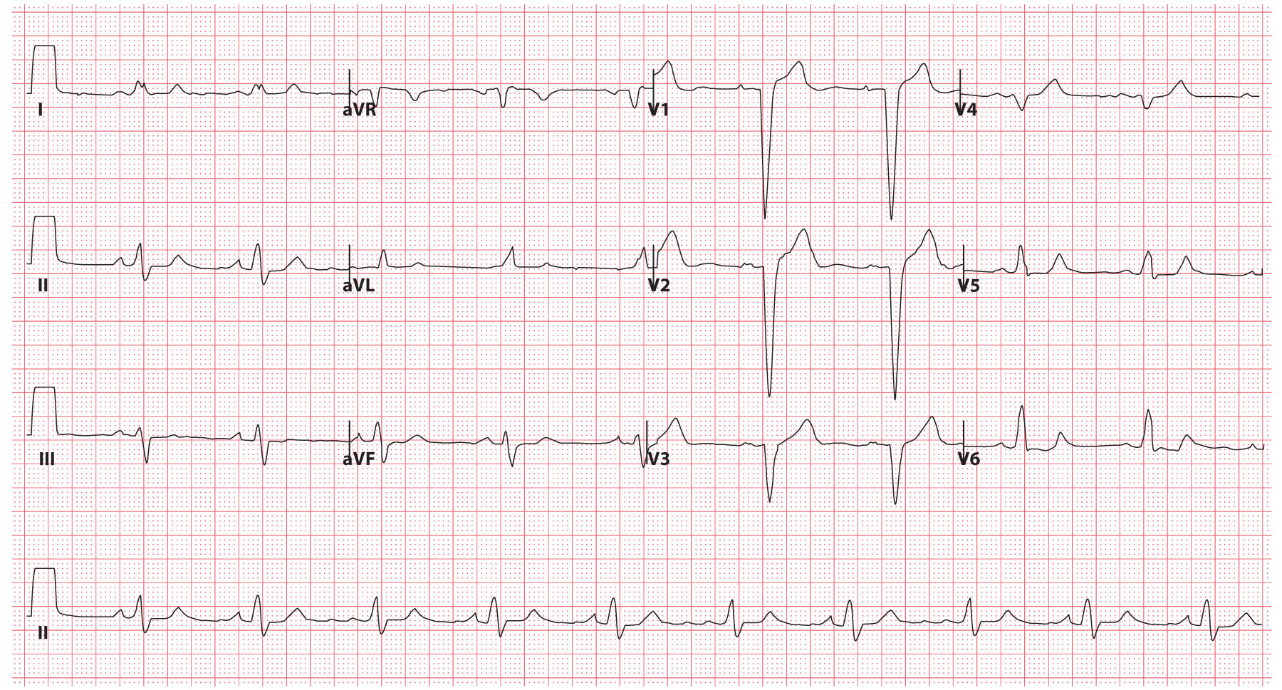 Medial Bundle Branch Block