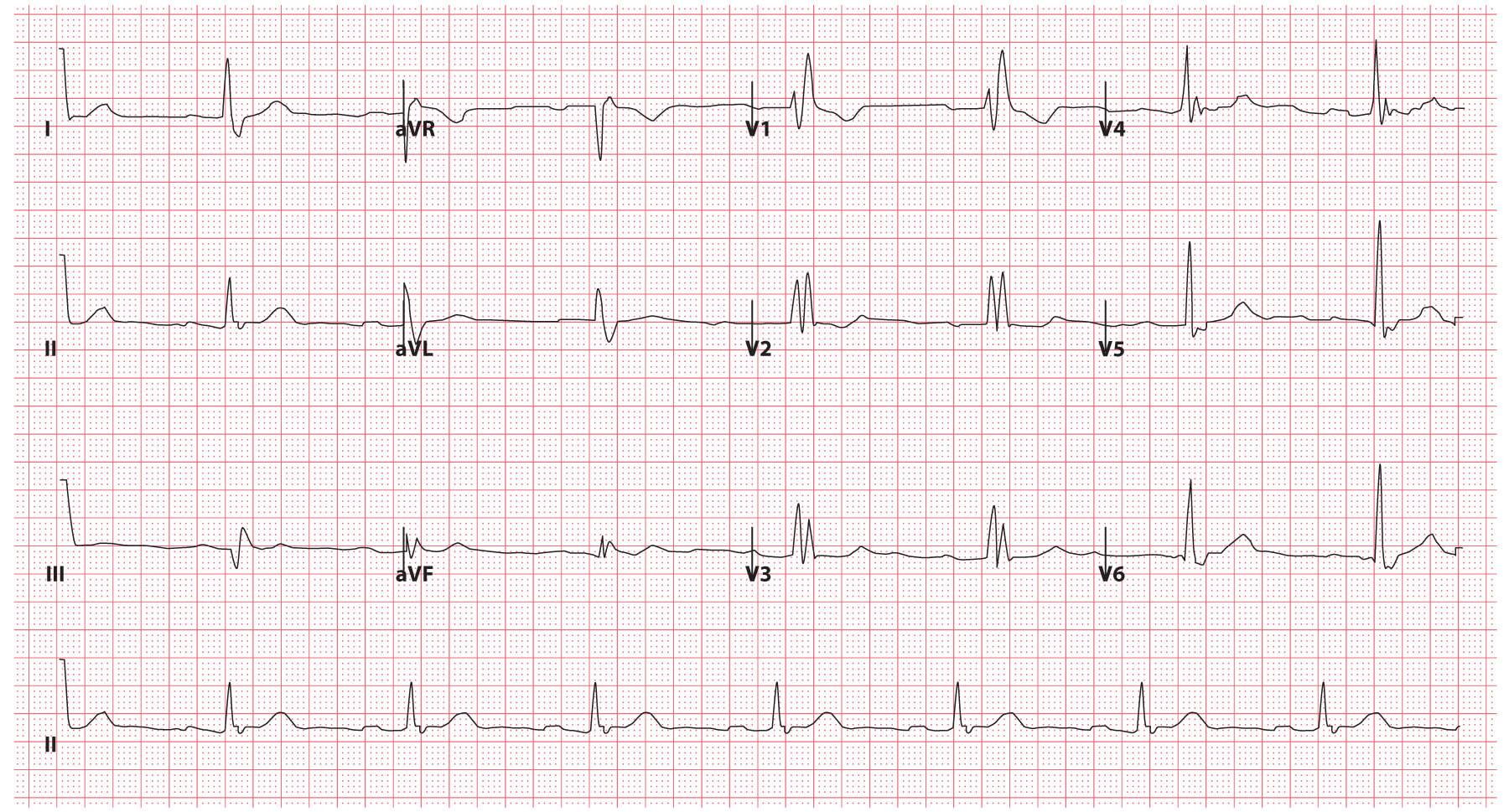 Empty ECG Paper