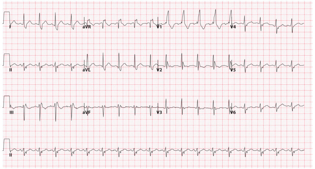Bundle Branch Blocks (Part 2 Fascicular Blocks) Medical Exam Prep