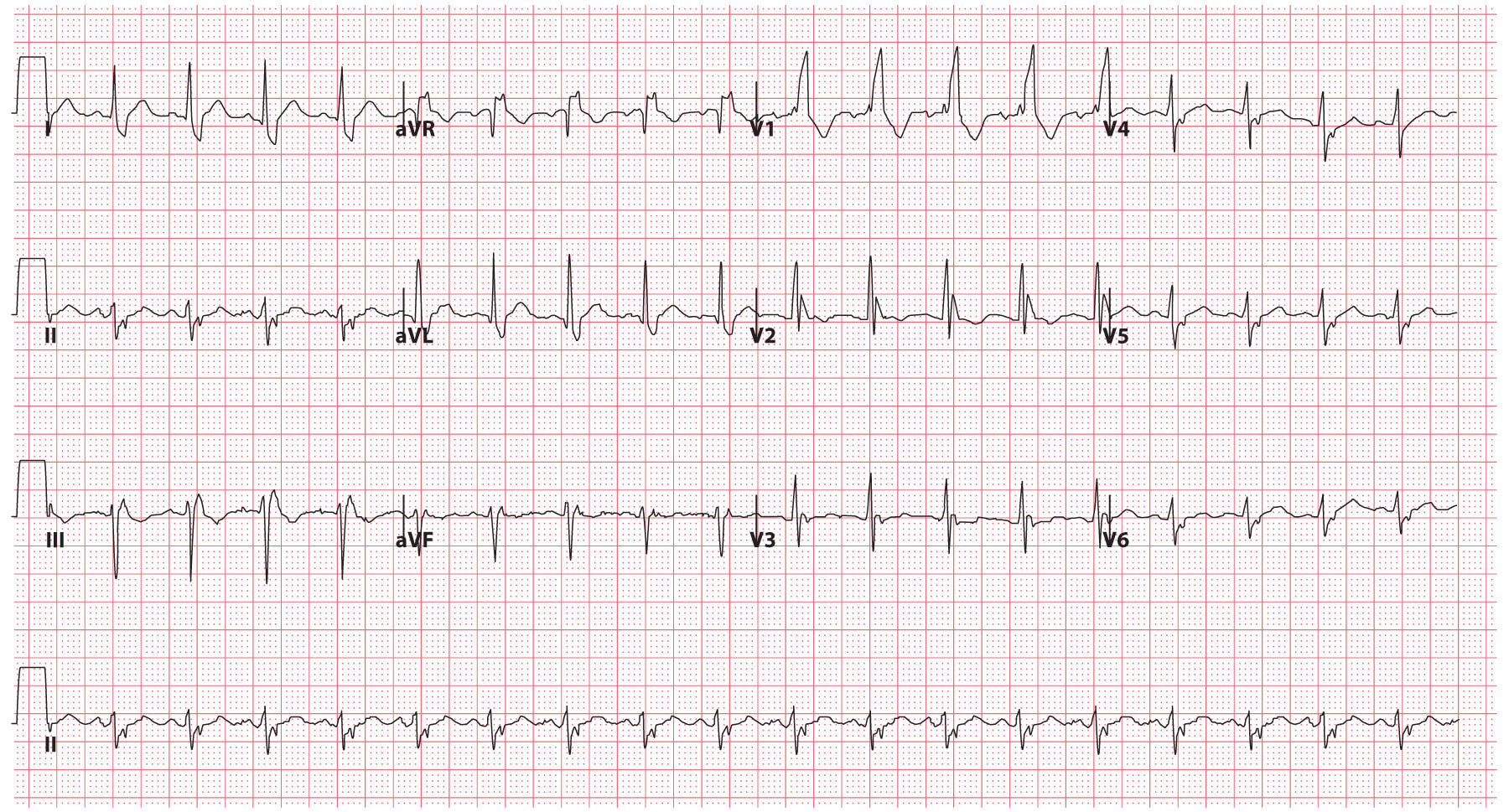 Bifascicular (RBBB and LAFB)