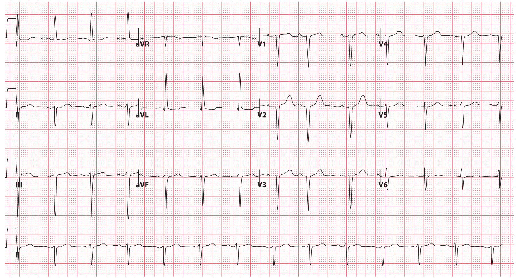 Left anterior fascicular block