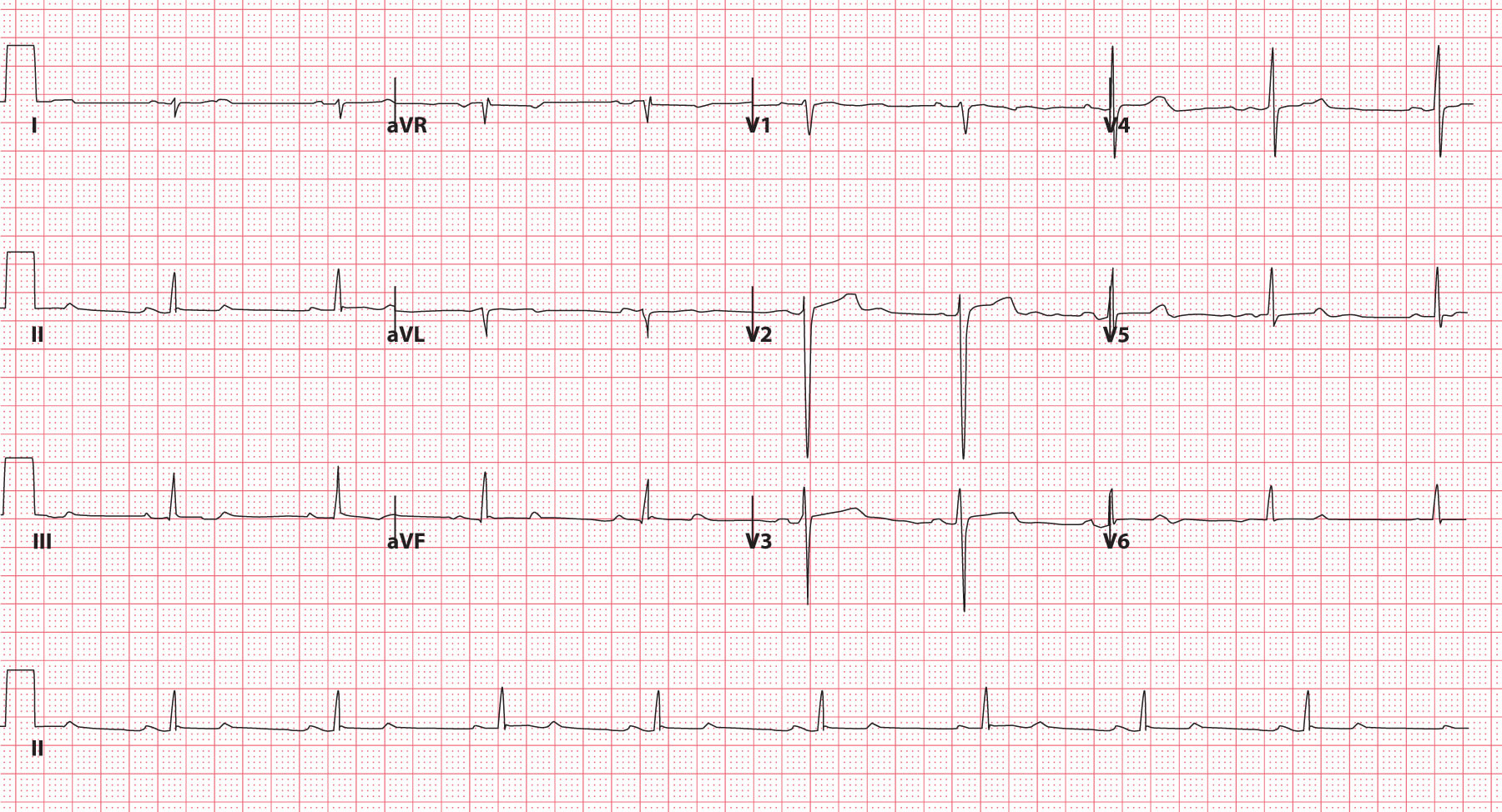 Left posterior fascicular block