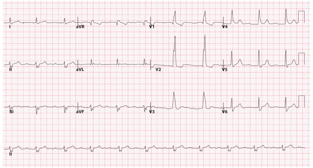 Bundle Branch Blocks (Part 2 Fascicular Blocks) Medical Exam Prep