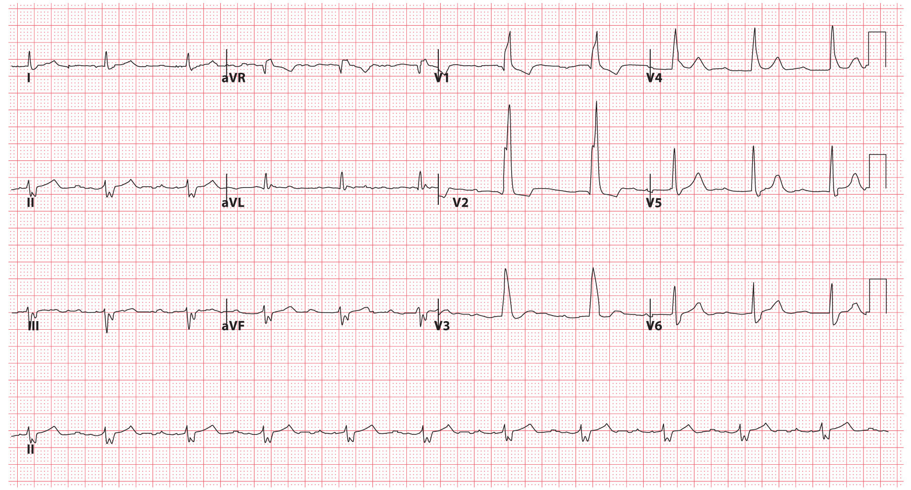 Trifascicular Block