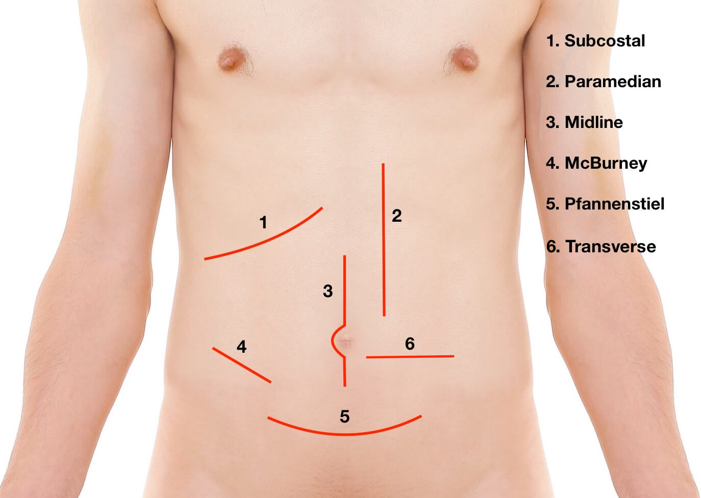 Groin Hernia Incision