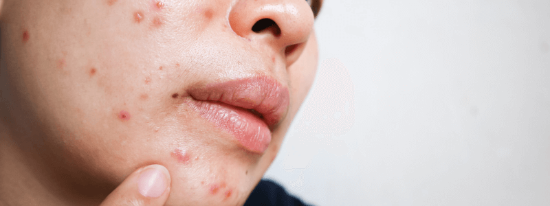 A Patient with Troublesome Acne