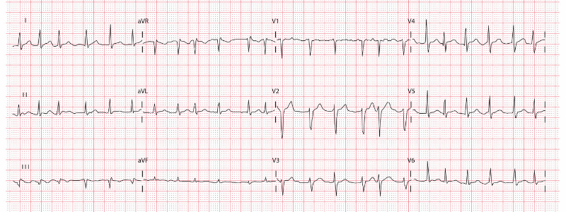 A 45-Year-Old Woman with Palpitations