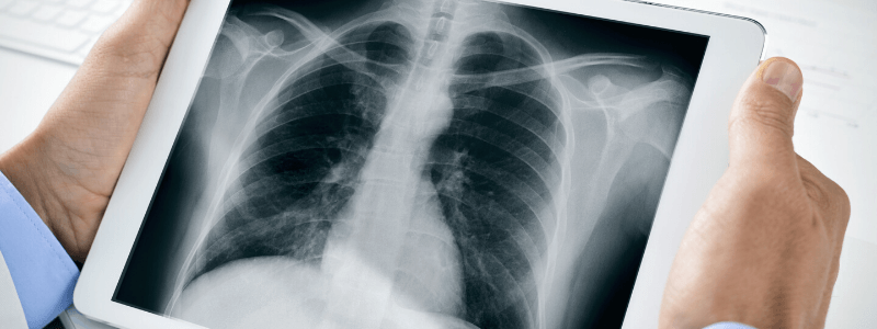 Diagnosing Pneumonia on Chest X-Ray
