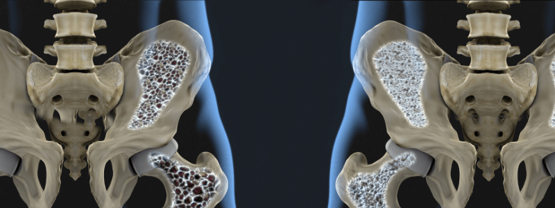 Osteoporosis Update Part 1 – Assessing Risk