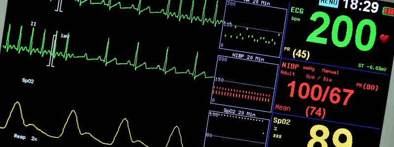 A 60-year-old Man with Dizziness and Palpitations