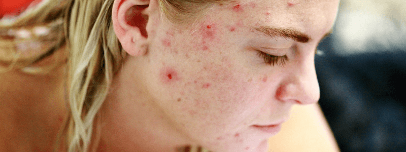 Managing Acne in Primary Care