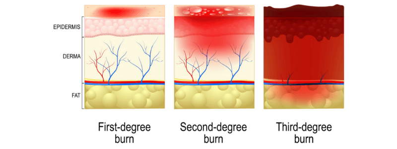 Thermal Burns: Background and Pathophysiology