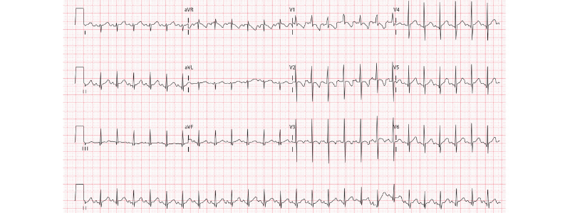 How To Read a Paediatric ECG