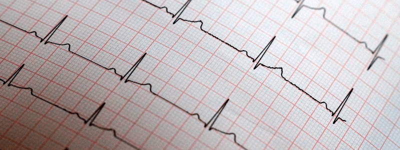 Test Your ECG Knowledge – Rate, Rhythm & Axis