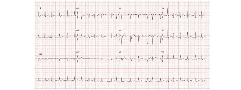 The Diagnosis and Management of Atrial Fibrillation
