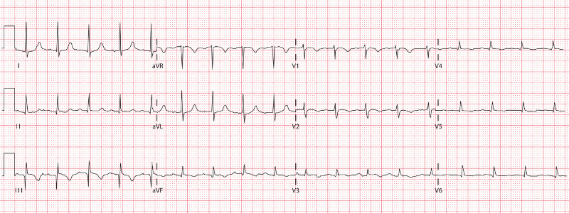 Recognising Myocardial Infarction Patterns on the ECG