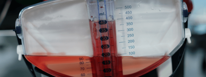 A 56-Year-Old Smoker with Haematuria