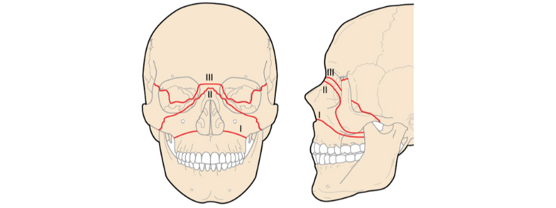 Le Fort Fractures