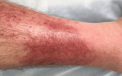 A 50-Year-Old man with a Painful, Swollen Leg