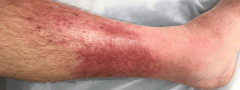 A 50-Year-Old man with a Painful, Swollen Leg