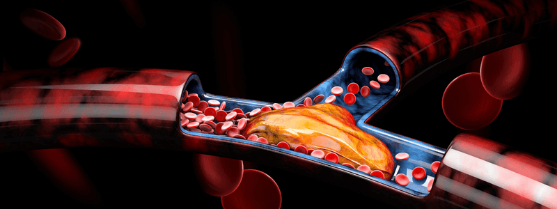 A Patient with a Suspected Pulmonary Embolus