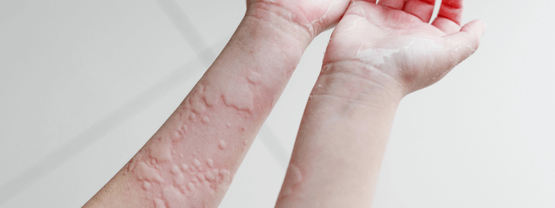 Urticaria