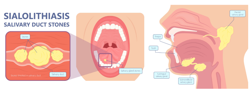 Sialolithiasis