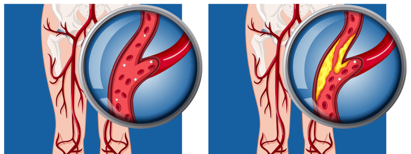 Acute Limb Ischaemia