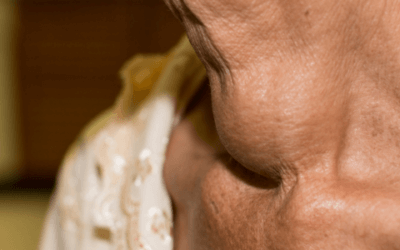 A 60-Year-Old Woman with a Neck Lump