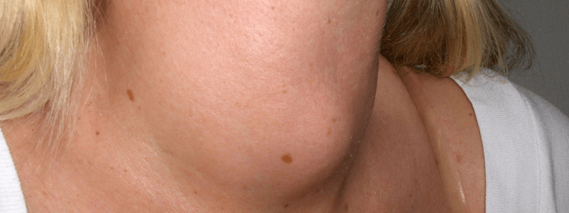 A 46-Year-Old Woman with Weight Loss and a Neck Lump