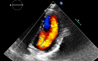 Acyanotic Congenital Heart Disease: A Radiologist’s Guide